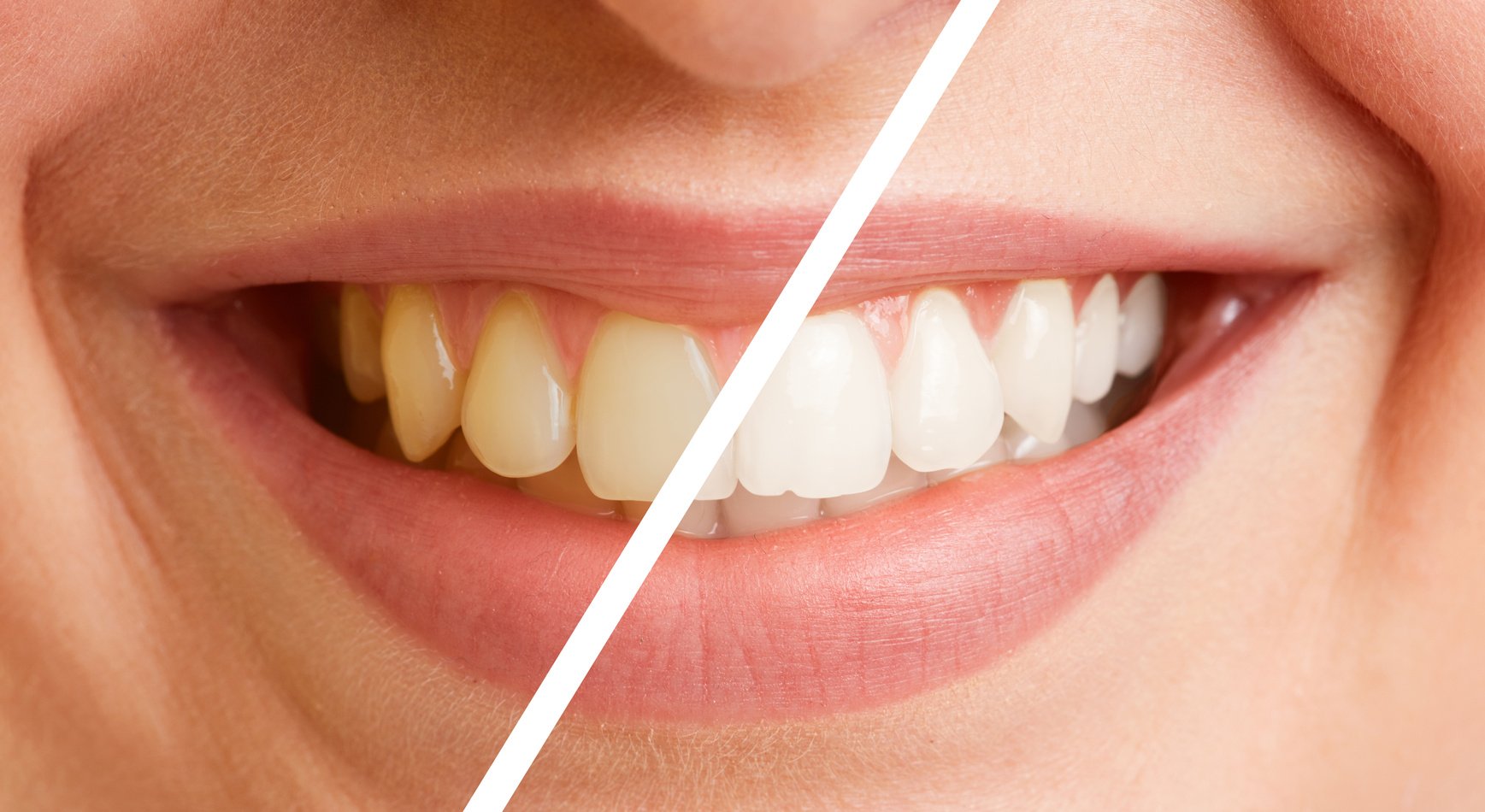 Comparison of Teeth before and after Tooth Cleaning